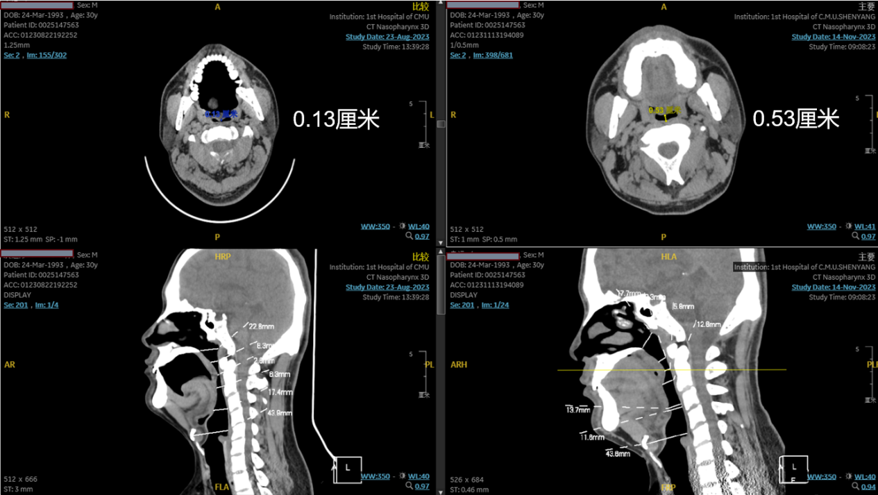 捷报：鼾克中频治疗仪取得新阶段性临床研究成果！！4