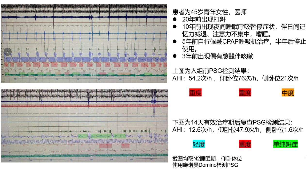 捷报：鼾克中频治疗仪取得新阶段性临床研究成果！！3